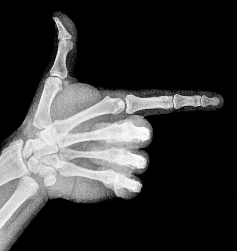 xray of a pointing finger